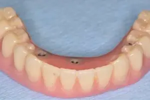 implant-four1