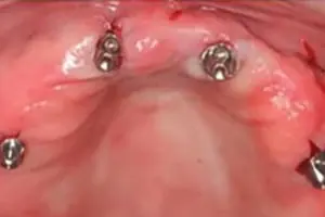 implant-four4