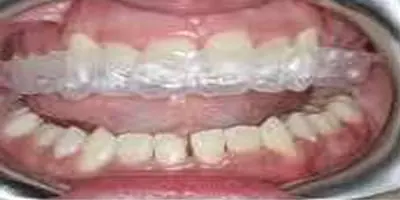 Retainers7