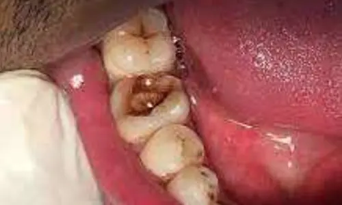 rootcanal4