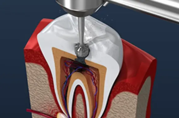 root-canal-home